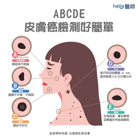 右下巴痣長毛|痣變大、痣多或長毛會變皮膚癌？認識痣的形成與原因